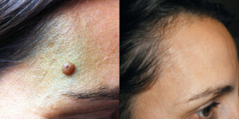 K-Laser-BLUE-Angioma-1024x511