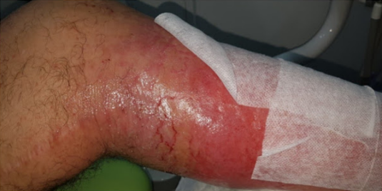 K-Laser-Vasculitis1