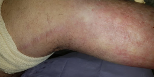 K-Laser-Vasculitis2